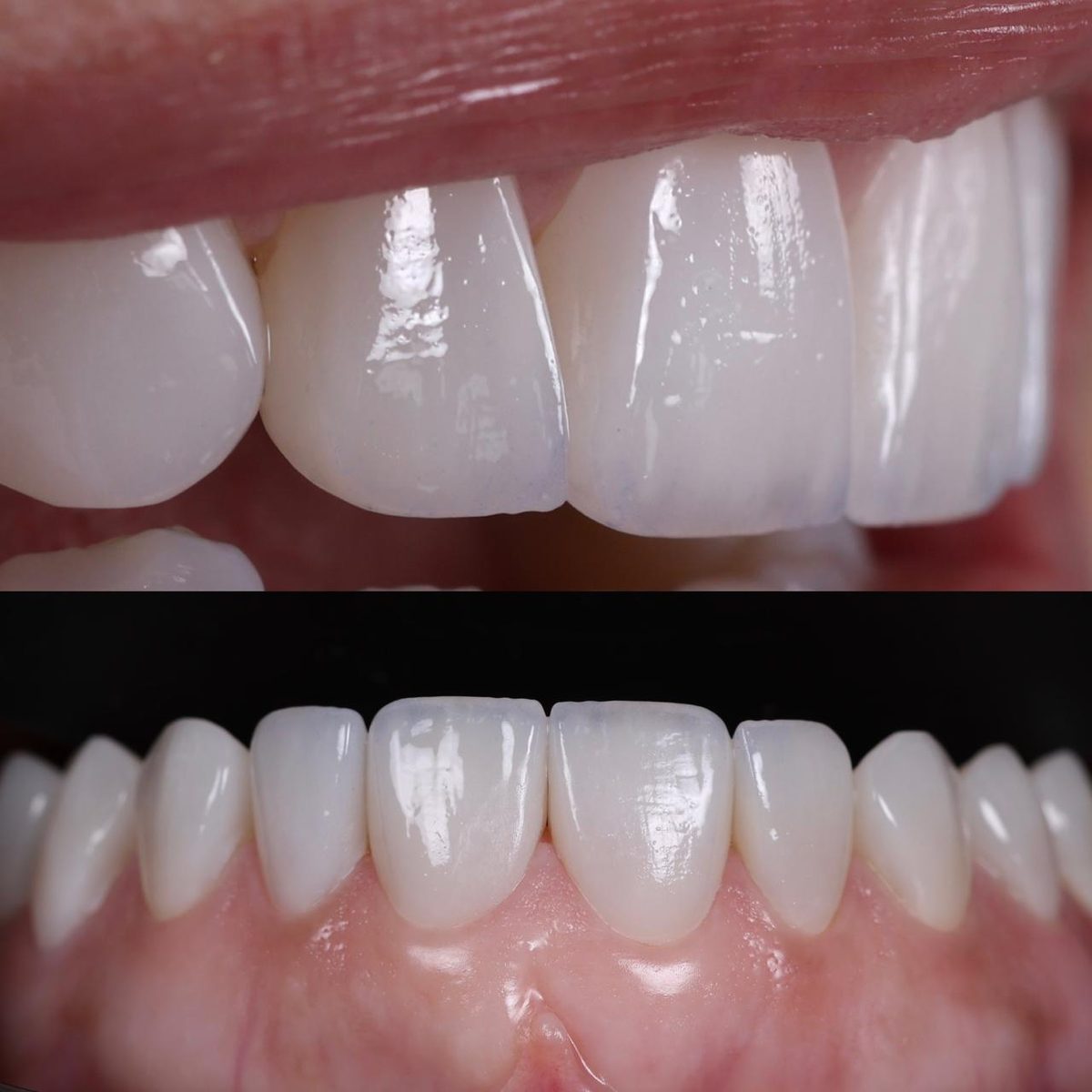 Detalle de carillas cerámicas con márgenes y textura hechos por un especialista