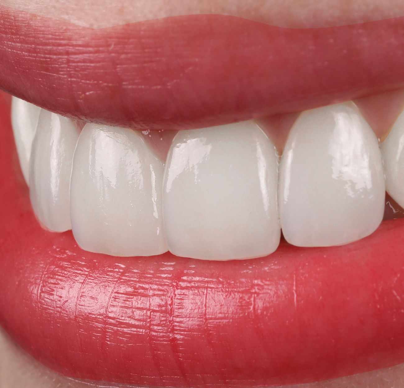 Sonrisa con carillas cerámicas en Medellín, Oral Center El Poblado