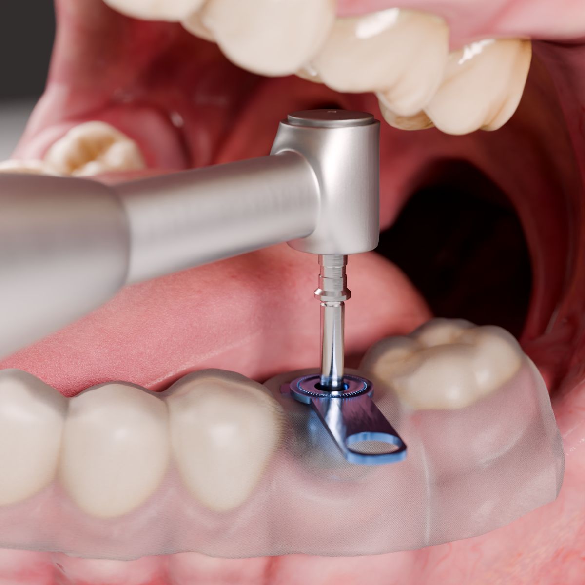 Cirugía guiada de implantes dentales con guía quirúrgica