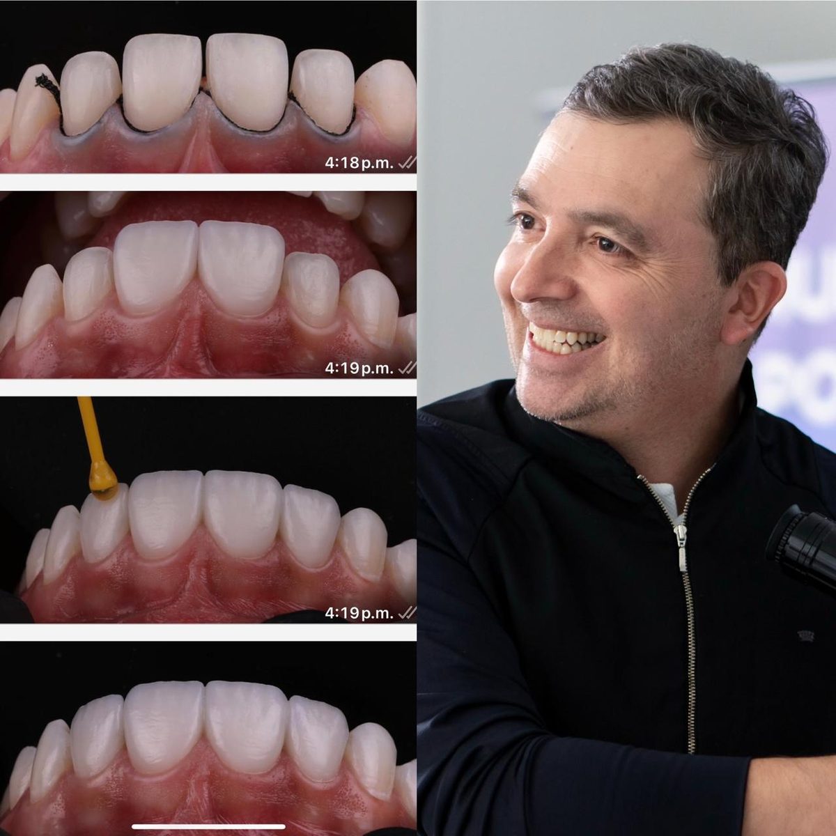 Dr. David Troncoso, rehabilitador oral, y secuencia de cementación de carillas cerámicas