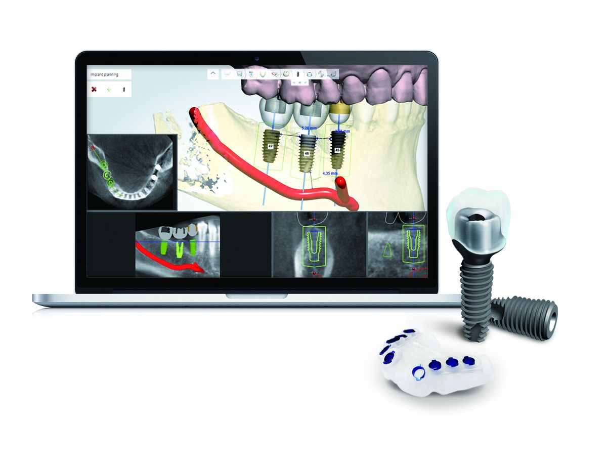 Planeación digital de implantes DIO en computador