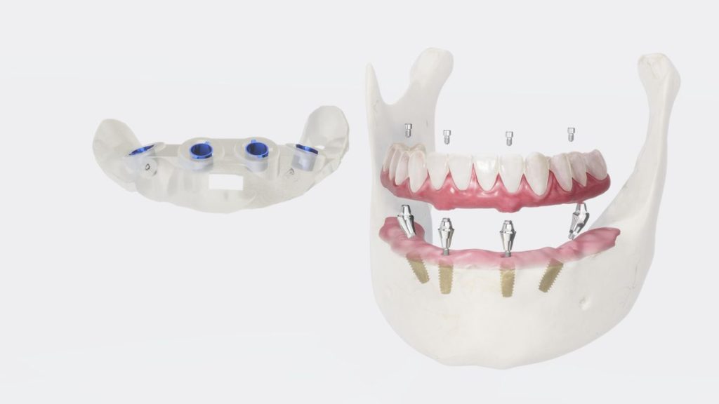 Prótesis completa sobre implantes dentales