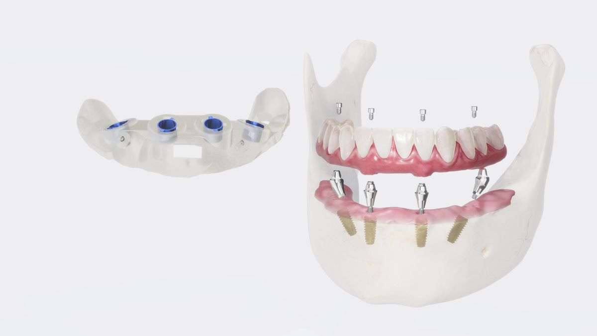 Prótesis completa sobre implantes dentales
